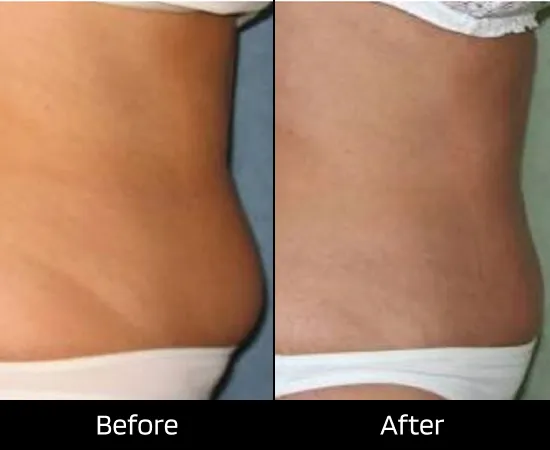Fat Removal Treatment in London