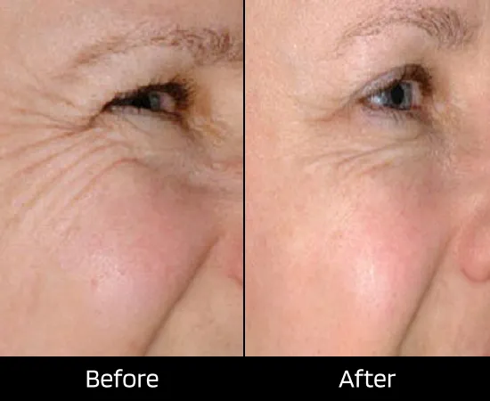 botox treatment in london