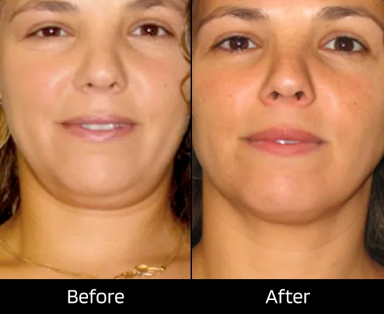 fillers treatment london