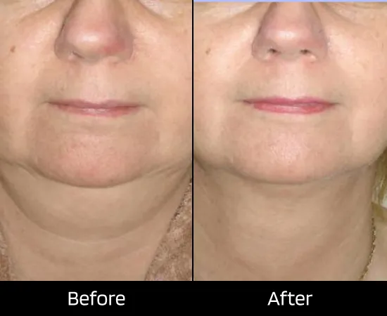 double chin reduction clinic in london