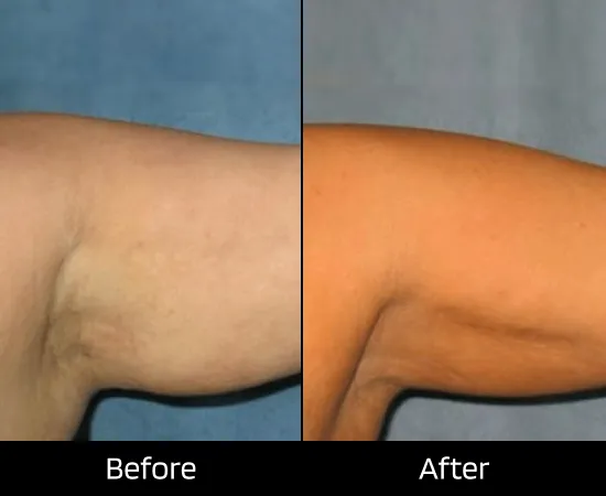laser hair removal clinic in london