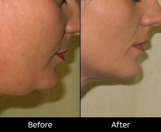 lipodissolve clinic in london