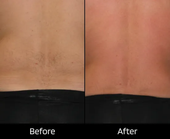 lipodissolve fat dissolving treatment