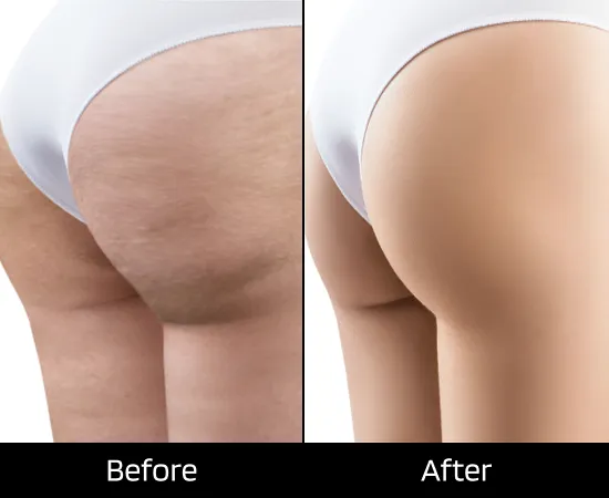 lipodissolve london for cellulite reduction