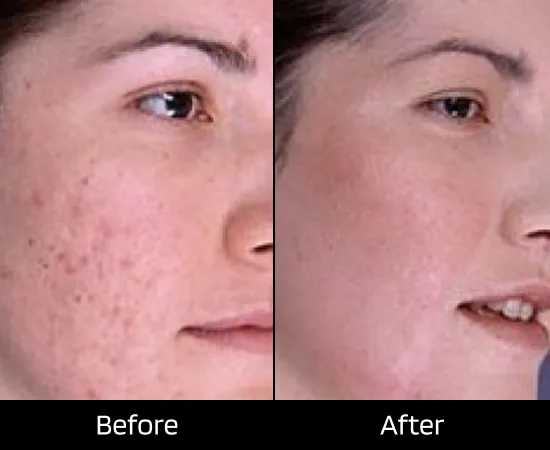 photodynamic therapy london for acne treatment