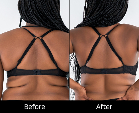 london lipo injections