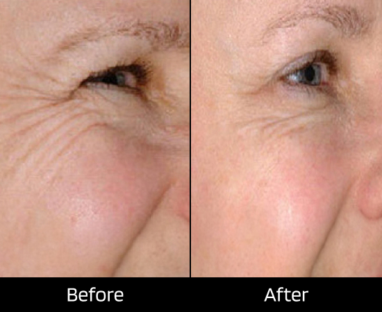 london spider vein laser treatment
