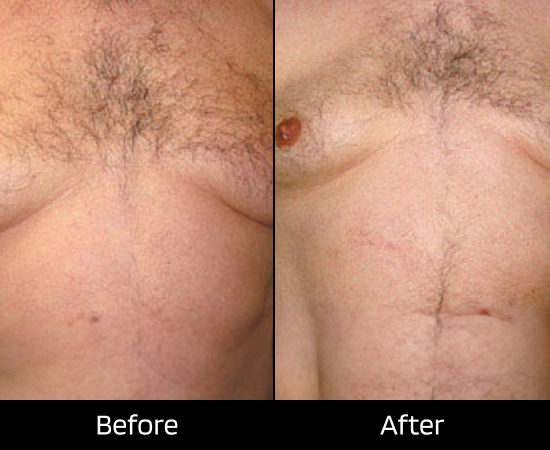 london surgical excision mole removal