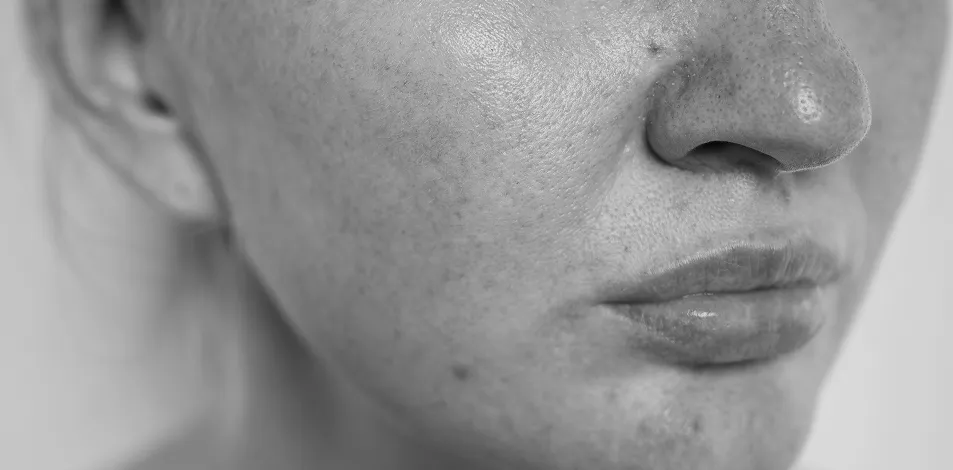 Laser Spider Vein Removal