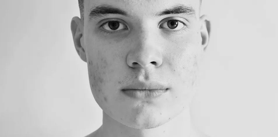 Photo Dynamic Therapy (PDT)