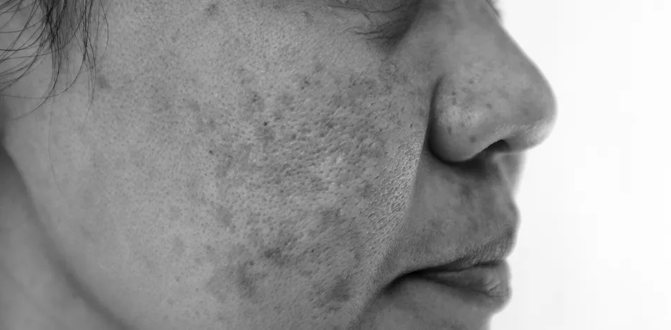 london chemical peel clinic