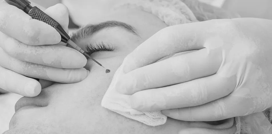 london lamprobe skin treatment clinic
