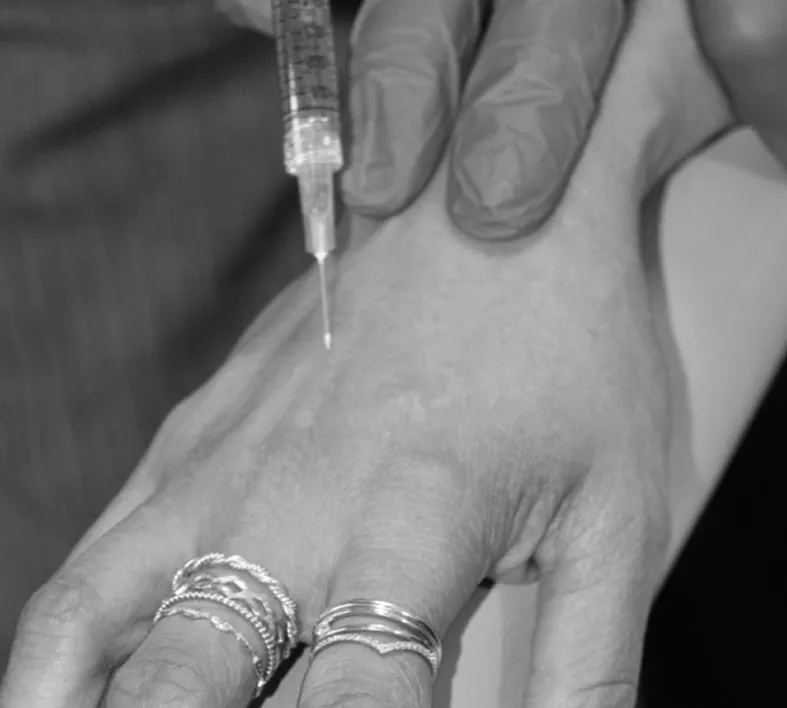 dermal fillers treatment in mississauga