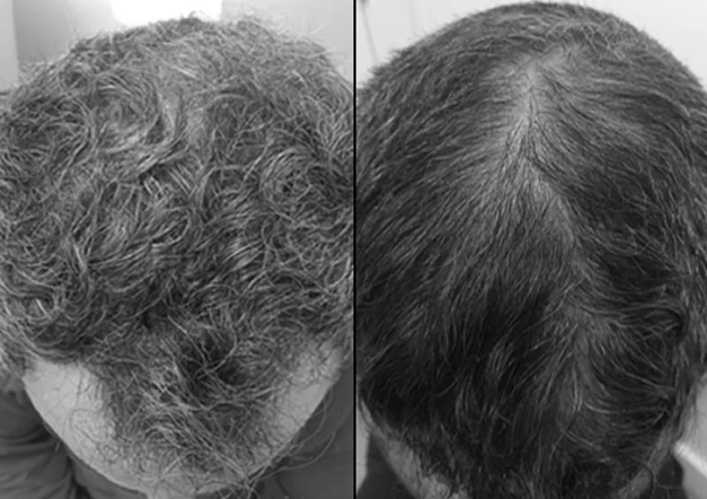 prp hair restoration mississauga