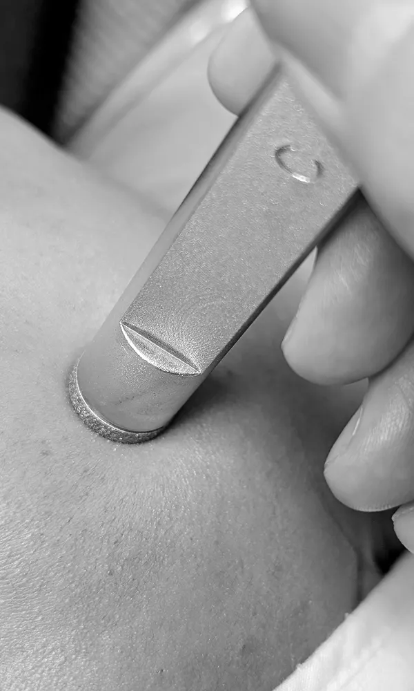 mississauga microdermabrasion
