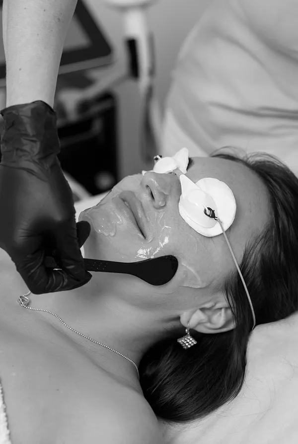 chemical peel mississauga for glowing skin