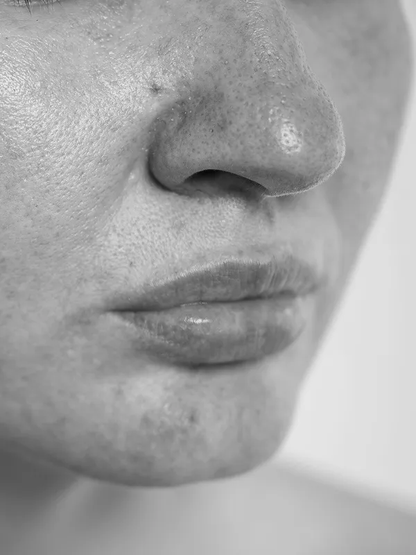 spider vein laser removal mississauga for broken capillaries