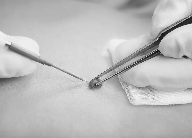 lamprobe mole removal treatment in mississauga