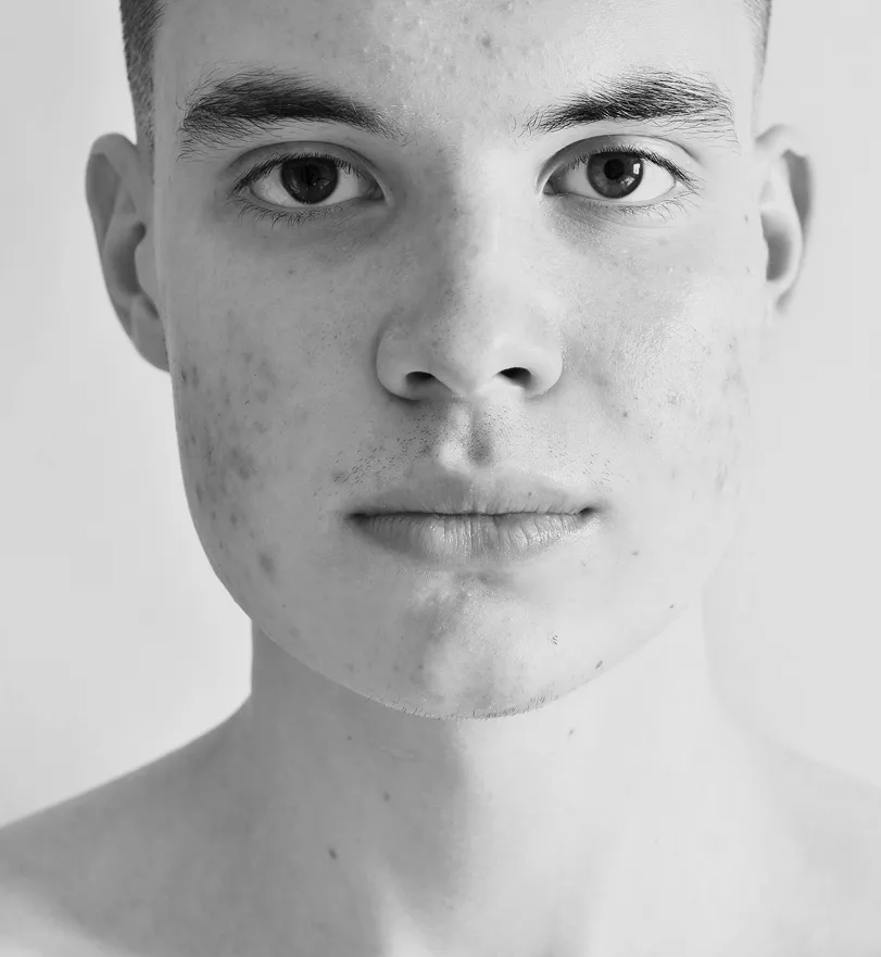 london expert chemical peel for acne