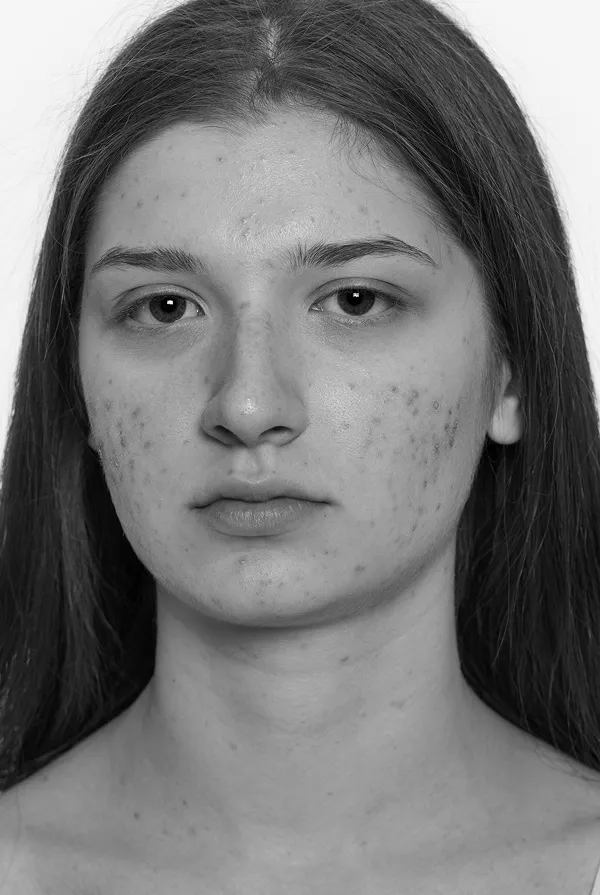 photodynamic therapy london for acne treatment
