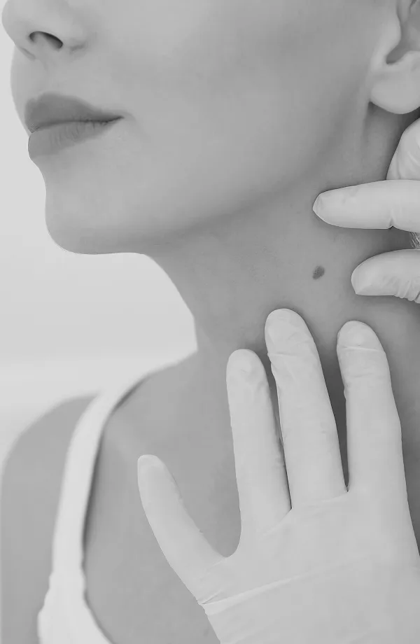 lamprobe skin tag removal clinic in london