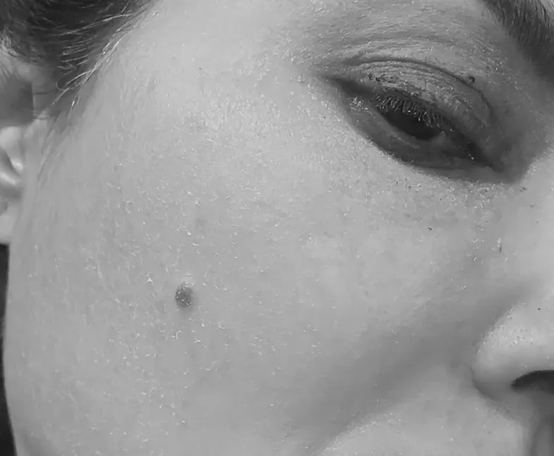 cosmetic mole removal london safe treatment